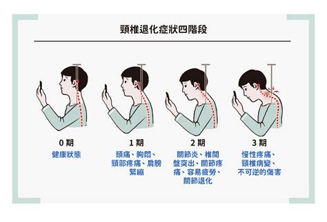 頭背|【頸背痛成因、症狀、運動】長期低頭頸椎退化變直 6。